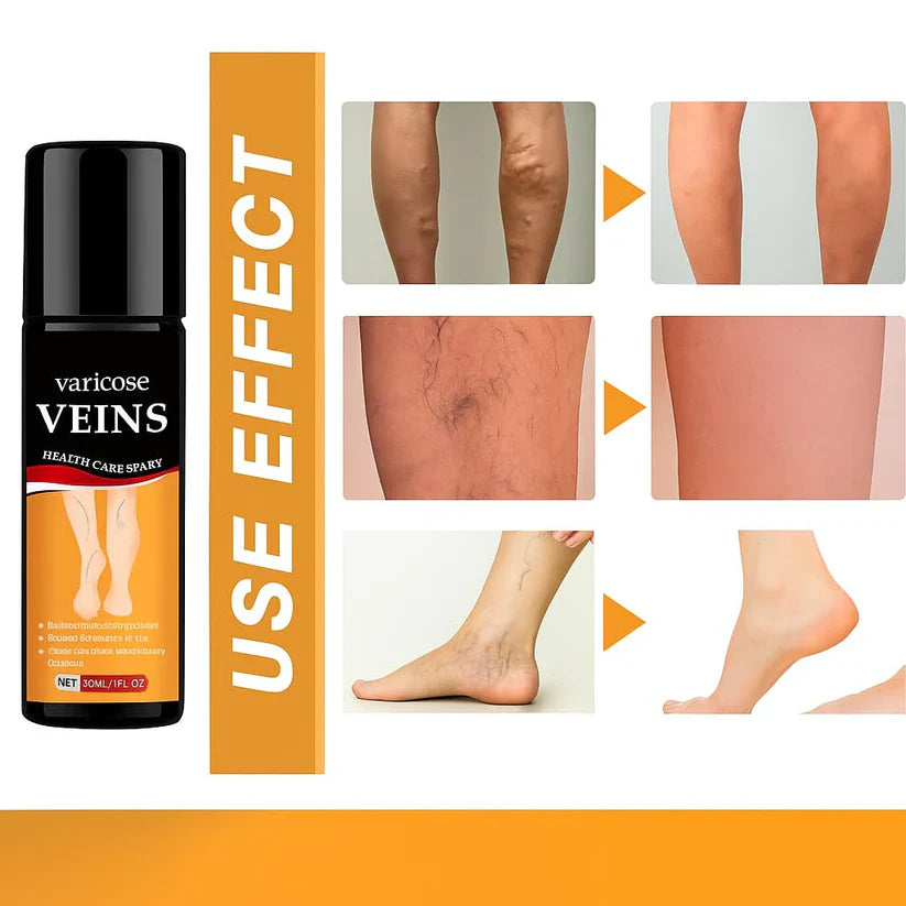 Turmeric Varicose Veins Relief Spray ( Buy 1 Get 1 Free )