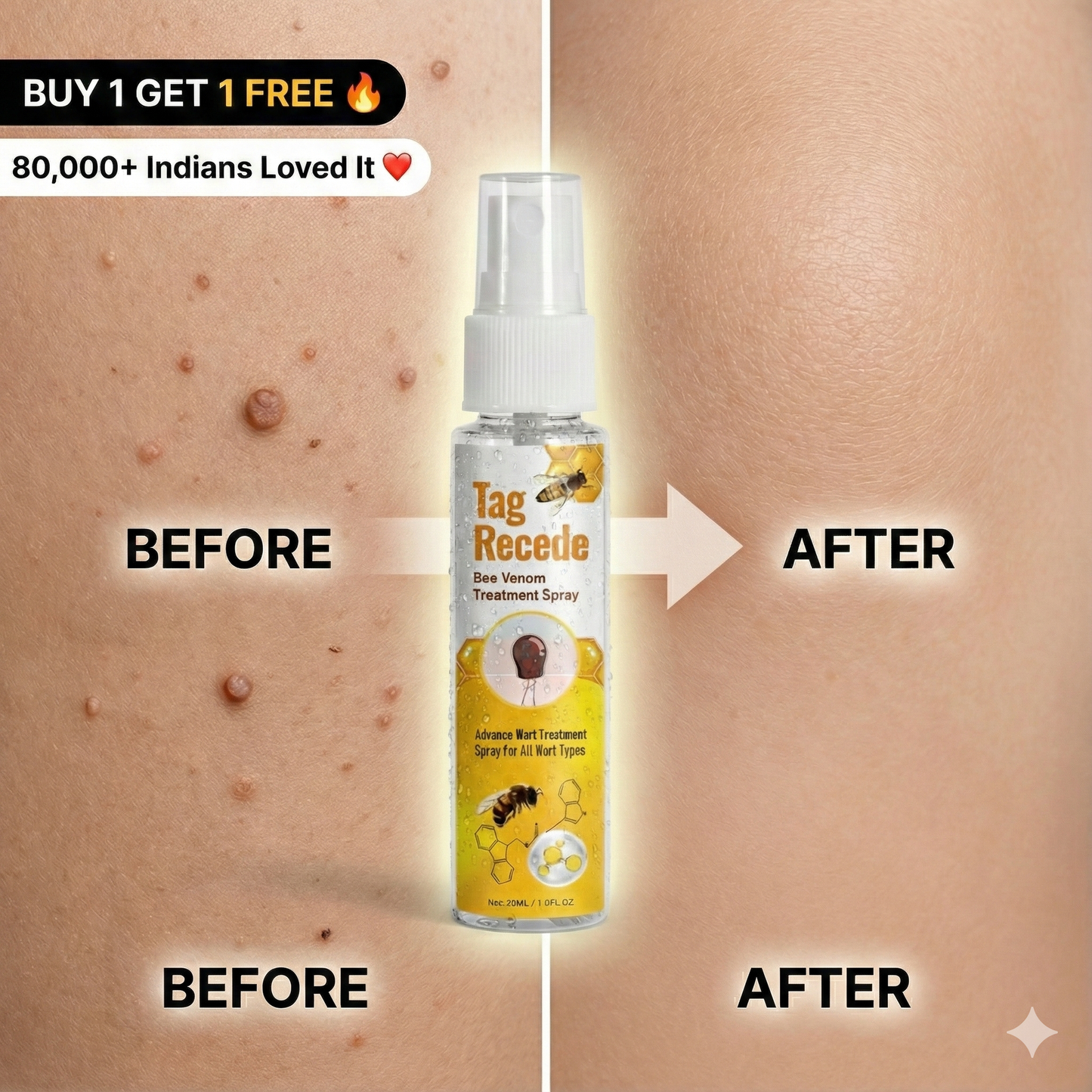 Wart & Maru (Skin Tag) Remover Spray - Buy 1 Get 1 FREE