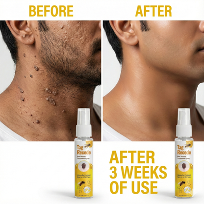 Wart & Maru (Skin Tag) Remover Spray - Buy 1 Get 1 FREE