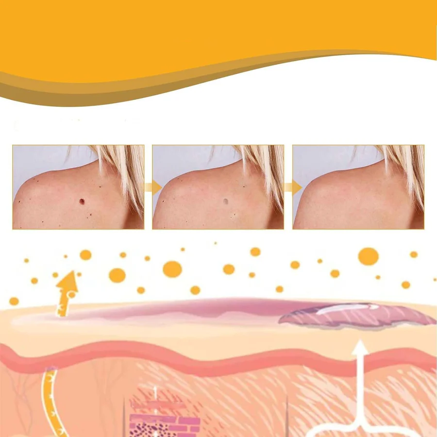 Wart & Maru (Skin Tag) Remover Spray - Buy 1 Get 1 FREE